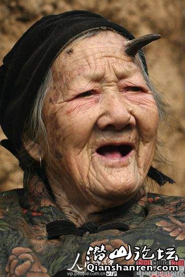 河南鲁山百岁老人头上长犄角 不疼也不痒(组图